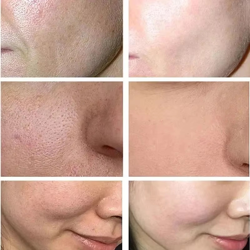 Salicylic Acid Pore Shrinking  - Azelaic Acid Cream review and price