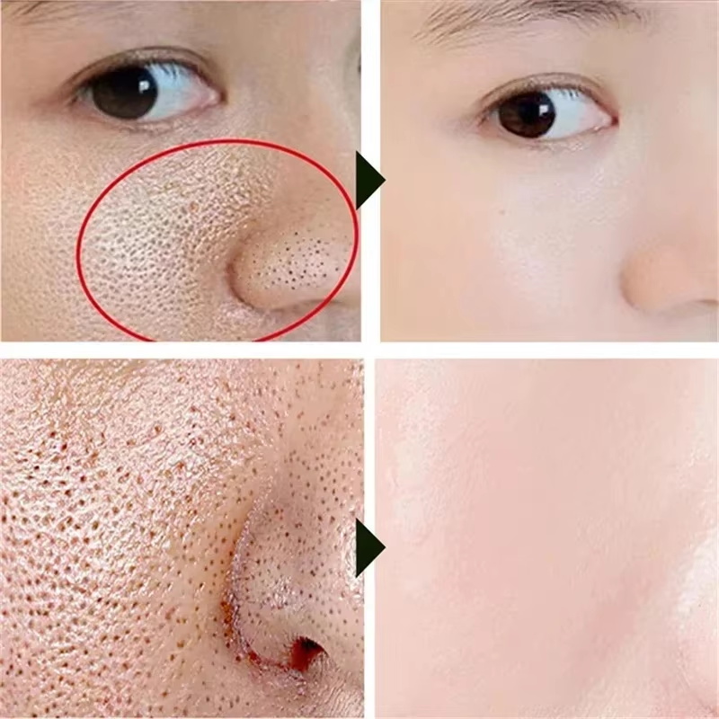 Salicylic Acid Pore Shrinking  - Azelaic Acid Cream review and price